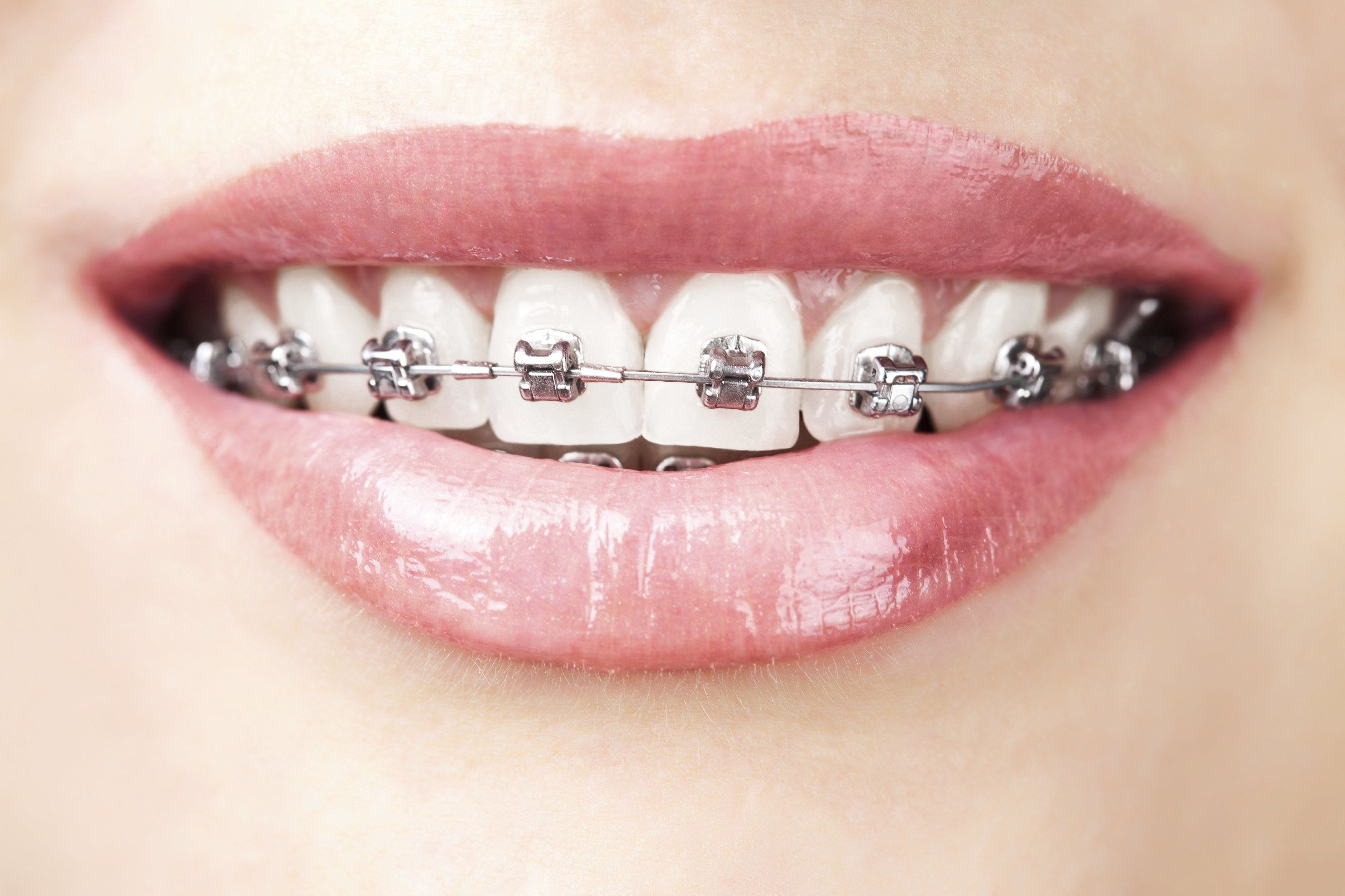 A person wearing braces