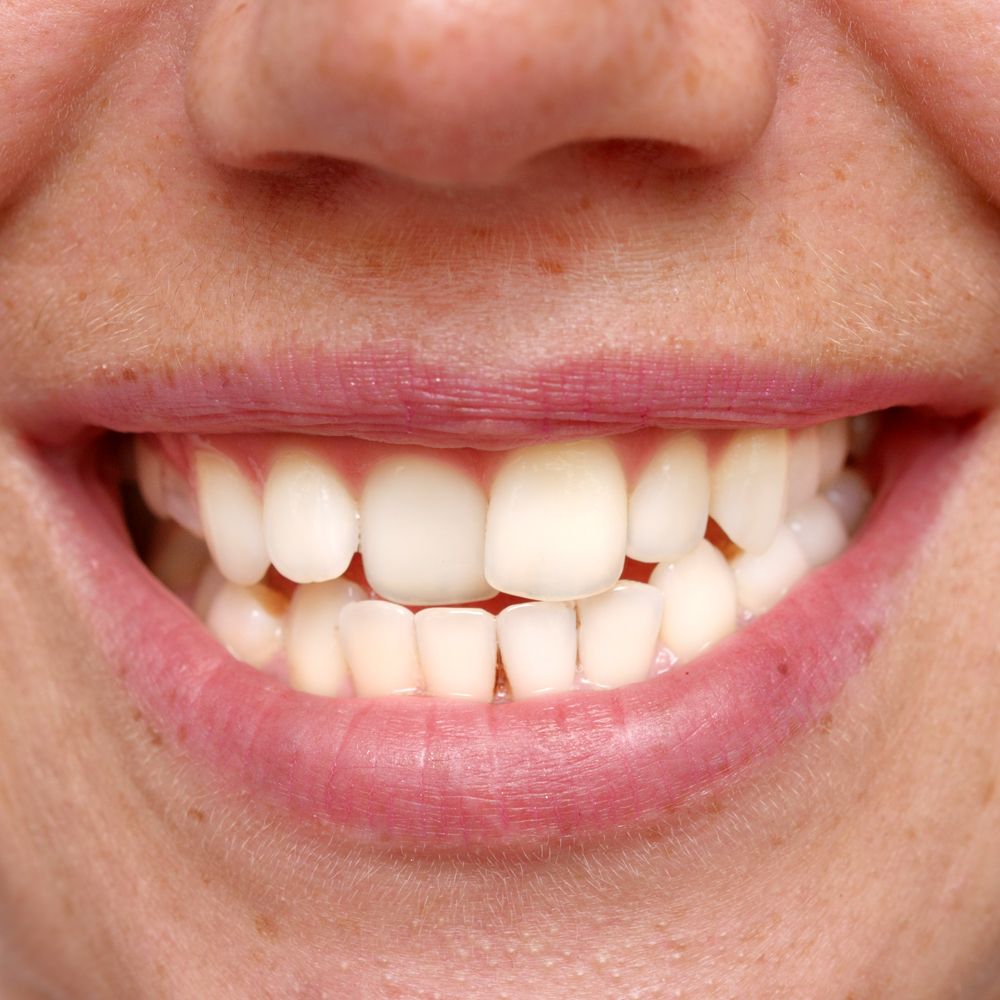 A person with misaligned teeth