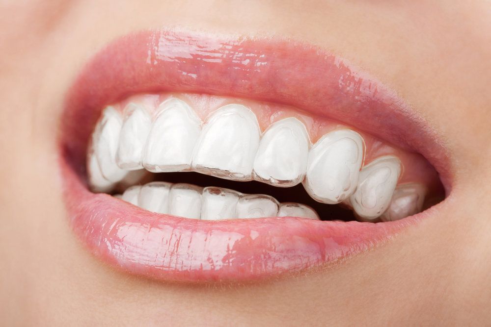 A person wearing Invisalign
