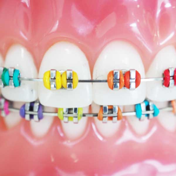 Colorful rubber bands on braces