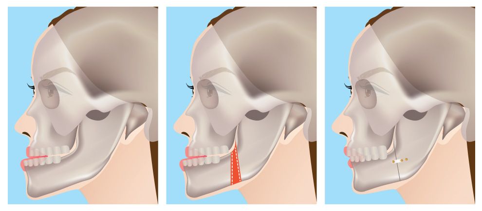 Illustration of how corrective jaw surgery can change jaw shape